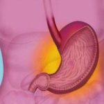 Чем лечить гастродуоденит Гастродуоденит: лечение препараты