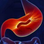 Формы и лечение гастродуоденита у взрослых и детей Формы и лечение гастродуоденита у взрослых и детей