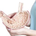 Причины и стадии рака желудка Причины и стадии рака желудка