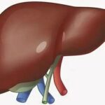 Причины стеатоза печени, лечение Причины стеатоза печени, лечение