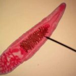 Как проявляется описторхоз, лечение Как проявляется описторхоз, лечение